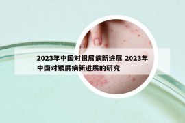 2023年中國(guó)對(duì)銀屑病新進(jìn)展 2023年中國(guó)對(duì)銀屑病新進(jìn)展的研究