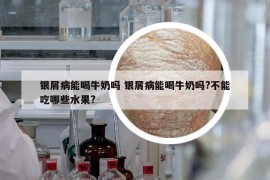 銀屑病能喝牛奶嗎 銀屑病能喝牛奶嗎?不能吃哪些水果?