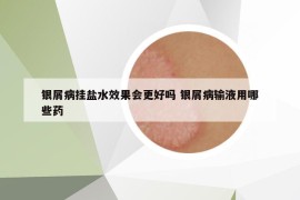 銀屑病掛鹽水效果會(huì)更好嗎 銀屑病輸液用哪些藥