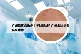 廣州銀屑病治療參考k康膚好 廣州皮膚病?？颇w康棒