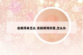 皮癬渾身怎么 皮蘚癢得厲害,怎么辦