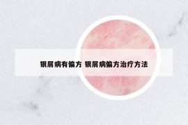 銀屑病有偏方 銀屑病偏方治療方法