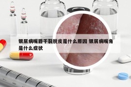 銀屑病嘴唇干裂脫皮是什么原因 銀屑病嘴角是什么癥狀