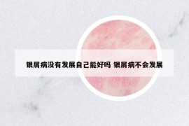 銀屑病沒有發(fā)展自己能好嗎 銀屑病不會發(fā)展