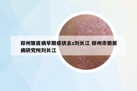 鄭州銀屑病早期癥狀去z劉長江 鄭州市銀屑病研究所劉長江