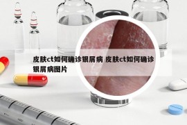 皮膚ct如何確診銀屑病 皮膚ct如何確診銀屑病圖片