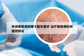 杭州銀屑病找哪個(gè)醫(yī)生看好 治療銀屑病杭州醫(yī)院排名