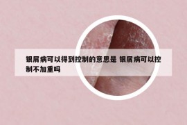 銀屑病可以得到控制的意思是 銀屑病可以控制不加重嗎