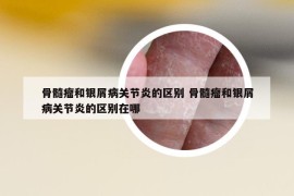 骨髓瘤和銀屑病關節(jié)炎的區(qū)別 骨髓瘤和銀屑病關節(jié)炎的區(qū)別在哪