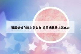 銀屑病長(zhǎng)在臉上怎么辦 銀屑病起臉上怎么辦