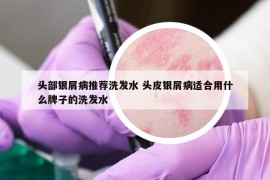 頭部銀屑病推薦洗發(fā)水 頭皮銀屑病適合用什么牌子的洗發(fā)水