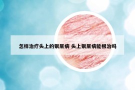 怎樣治療頭上的銀屑病 頭上銀屑病能根治嗎