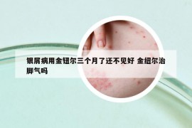 銀屑病用金鈕爾三個(gè)月了還不見好 金紐爾治腳氣嗎