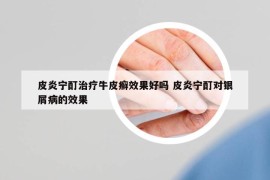 皮炎寧酊治療牛皮癬效果好嗎 皮炎寧酊對(duì)銀屑病的效果