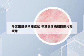 尋常銀屑病早期癥狀 尋常銀屑病初期圖片和現(xiàn)象