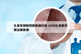 禮來生物制劑銀屑病價格 2020禮來新藥根治銀屑病