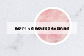 枸杞子牛皮癬 枸杞對銀屑病有副作用嗎