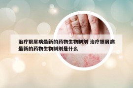 治療銀屑病最新的藥物生物制劑 治療銀屑病最新的藥物生物制劑是什么