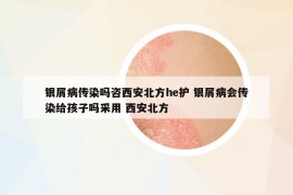 銀屑病傳染嗎咨西安北方he護 銀屑病會傳染給孩子嗎采用 西安北方