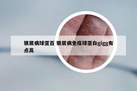 銀屑病球蛋百 銀屑病免疫球蛋白gigg有點(diǎn)高