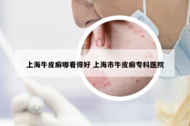 上海牛皮癬哪看得好 上海市牛皮癬專科醫(yī)院