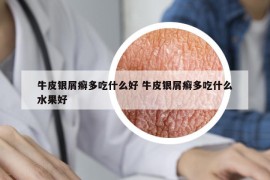 牛皮銀屑癬多吃什么好 牛皮銀屑癬多吃什么水果好