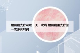 銀屑病光療可以一天一次嗎 銀屑病用光療法一次多長(zhǎng)時(shí)間