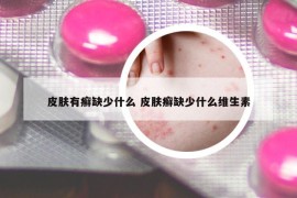皮膚有癬缺少什么 皮膚癬缺少什么維生素