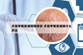 手指甲銀屑病初期癥狀 手指甲銀屑病用什么藥膏