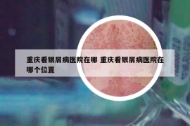 重慶看銀屑病醫(yī)院在哪 重慶看銀屑病醫(yī)院在哪個(gè)位置