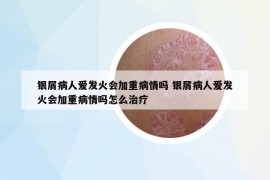 銀屑病人愛發(fā)火會加重病情嗎 銀屑病人愛發(fā)火會加重病情嗎怎么治療