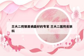 蘭大二院銀屑病最好的專家 蘭大二醫(yī)院皮膚科