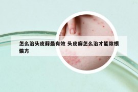 怎么治頭皮蘚最有效 頭皮癬怎么治才能除根偏方