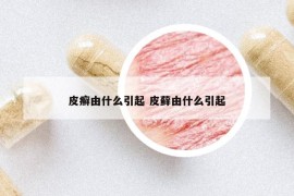皮癬由什么引起 皮蘚由什么引起