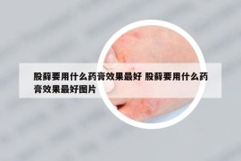 股蘚要用什么藥膏效果最好 股蘚要用什么藥膏效果最好圖片