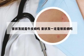 束狀發(fā)就是牛皮癬嗎 束狀發(fā)一定是銀屑病嗎
