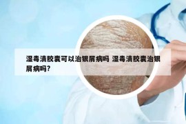 濕毒清膠囊可以治銀屑病嗎 濕毒清膠囊治銀屑病嗎?