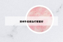 鄭州牛皮癬治療那里好
