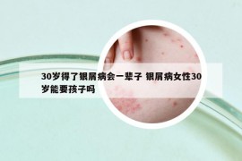 30歲得了銀屑病會一輩子 銀屑病女性30歲能要孩子嗎