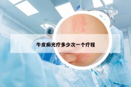 牛皮癬光療多少次一個療程