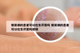 銀屑病的患者可以吃生芹菜嗎 銀屑病的患者可以吃生芹菜嗎視頻