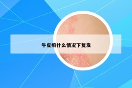 牛皮癬什么情況下復(fù)發(fā)
