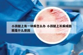 小孩腿上有一塊癬怎么辦 小孩腿上長(zhǎng)癬成圓圈是什么原因