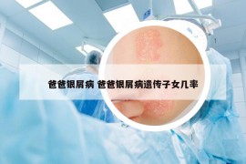 爸爸銀屑病 爸爸銀屑病遺傳子女幾率