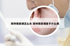 斑塊銀屑病怎么辦 斑塊銀屑病屬于什么病