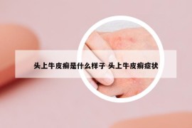 頭上牛皮癬是什么樣子 頭上牛皮癬癥狀