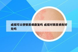 戒煙可以使銀屑病康復嗎 戒煙對銀屑病有好處嗎