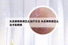 頭皮癬銀屑病怎么治療方法 頭皮銀屑病怎么治才能斷根
