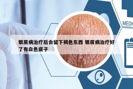 銀屑病治療后會(huì)留下褐色東西 銀屑病治療好了有白色底子