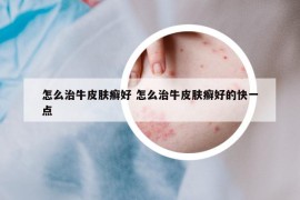 怎么治牛皮膚癬好 怎么治牛皮膚癬好的快一點